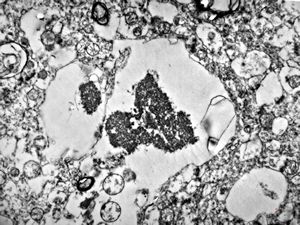 M,71y. | Alzheimer diseaseaccompanied with CADASIL - hyaline body in astrocyte M,71y. | Alzheimer diseaseaccompanied with CADASIL - hyaline body in astrocyte
